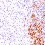 Formalin-fixed, paraffin-embedded human Hodgkin's Lymphoma stained with CD3 Monoclonal Antibody (SPM69).