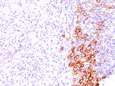 Formalin-fixed, paraffin-embedded human Hodgkin's Lymphoma stained with CD3 Monoclonal Antibody (SPM69).