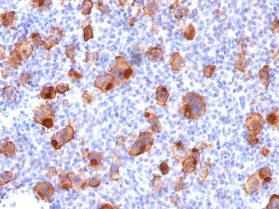 Formalin-fixed, paraffin-embedded human Hodgkins Lymphoma stained with CD3 Recombinant Mouse Monoclonal Antibody (rKi-1/779).