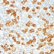 Formalin-fixed, paraffin-embedded human Hodgkin's Lymphoma stained with CD3 Recombinant Rabbit Monoclonal Antibody (Ki-1/155R).