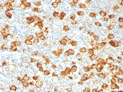 Formalin-fixed, paraffin-embedded human Hodgkin's Lymphoma stained with CD3 Recombinant Rabbit Monoclonal Antibody (Ki-1/155R).