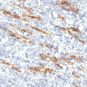Formalin-fixed, paraffin-embedded human Angiosarcoma stained with CD34 Monoclonal Antibody (QBEnd/1 + HPCA1/763)