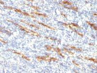 Formalin-fixed, paraffin-embedded human Angiosarcoma stained with CD34 Monoclonal Antibody (QBEnd/1 + HPCA1/763)