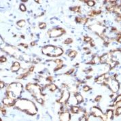 Formalin-fixed, paraffin-embedded human Angiosarcoma stained with CD34 Monoclonal Antibody (SPM61)