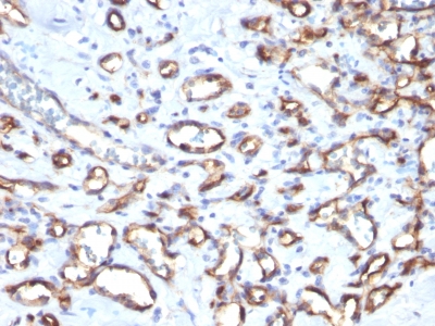 Formalin-fixed, paraffin-embedded human Angiosarcoma stained with CD34 Monoclonal Antibody (SPM61)