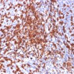 Formalin-fixed, paraffin-embedded human Breast Carcinoma stained with CD44 Monoclonal Antibody (156-3C11)