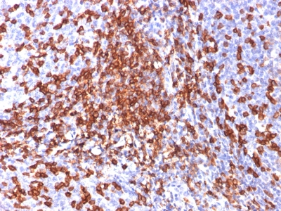 Formalin-fixed, paraffin-embedded human Breast Carcinoma stained with CD44 Monoclonal Antibody (156-3C11)