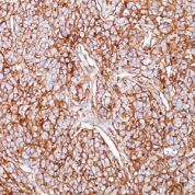 Formalin-fixed, paraffin-embedded human Breast Carcinoma stained with CD44 Monoclonal Antibody (SPM521)