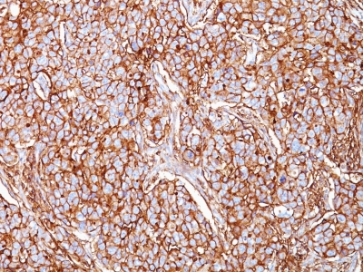 Formalin-fixed, paraffin-embedded human Breast Carcinoma stained with CD44 Monoclonal Antibody (SPM521)