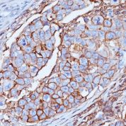 Formalin-fixed, paraffin-embedded human Breast Carcinoma stained with CD44 Monoclonal Antibody (DF1485)