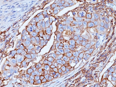 Formalin-fixed, paraffin-embedded human Breast Carcinoma stained with CD44 Monoclonal Antibody (DF1485)