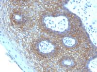 Formalin-paraffin human Tongue Squamous Cell Carcinoma stained with CD44v4 Monoclonal Antibody (CD44v4/1219)