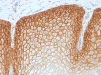 Formalin-paraffin human Cervical Squamous Cell Carcinoma stained with CD44v4 Recombinant Rabbit Monoclonal Antibody (CD44v4/17)