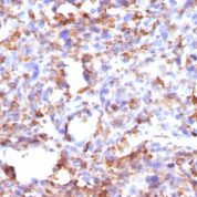 Formalin-fixed, paraffin-embedded human Histiocytoma stained with CD68 Monoclonal Antibody (CD68/G2).