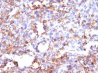 Formalin-fixed, paraffin-embedded human Histiocytoma stained with CD68 Monoclonal Antibody (CD68/G2).