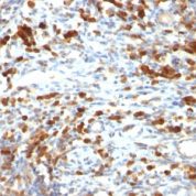 Formalin-fixed, paraffin-embedded human Lymphoma stained with CD79a Monoclonal Antibody (IGA/764).