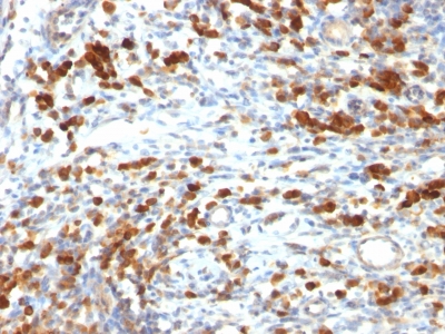 Formalin-fixed, paraffin-embedded human Lymphoma stained with CD79a Monoclonal Antibody (IGA/764).
