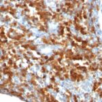 Formalin-fixed, paraffin-embedded human Lymphoma stained with CD79a Monoclonal Antibody (IGA/515).