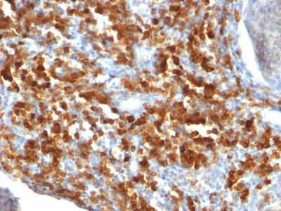 Formalin-fixed, paraffin-embedded human Lymphoma stained with CD79a Monoclonal Antibody (IGA/515).