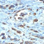 Formalin-fixed, paraffin-embedded human Gastric Carcinoma stained with CDC2 Monoclonal Antibody (AR12)