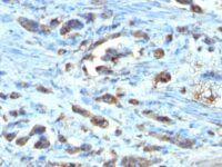 Formalin-fixed, paraffin-embedded human Gastric Carcinoma stained with CDC2 Monoclonal Antibody (AR12)