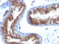 Formalin-fixed, paraffin-embedded human Breast Carcinoma stained with MVP Monoclonal Antibody (132).