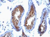 Formalin-fixed, paraffin-embedded human Testicular Carcinoma stained with MVP Monoclonal Antibody (SPM28).