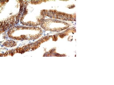 Formalin-fixed, paraffin-embedded human Colon Carcinoma stained with E-Cadherin Monoclonal Antibody (CDH1/1121).