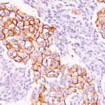 Formalin-fixed, paraffin-embedded human Breast Carcinoma stained with Phosphotyrosine Monoclonal Antibody (PY2).