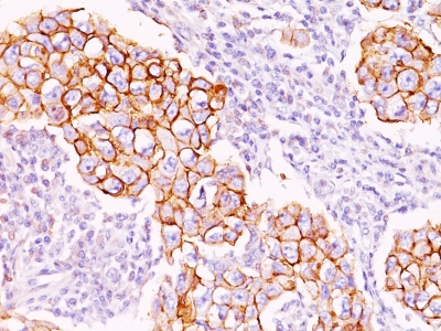 Formalin-fixed, paraffin-embedded human Breast Carcinoma stained with Phosphotyrosine Monoclonal Antibody (PY2).