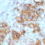 Formalin-paraffin human Gastric Carcinoma stained with CA19-9 MAb (121SLE).