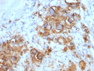 Formalin-paraffin human Gastric Carcinoma stained with CA19-9 MAb (121SLE).