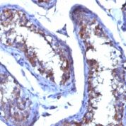 Formalin-fixed. Paraffin-embedded human Testicular Carcinoma stained with Testosterone Monoclonal Antibody (4E1G2)