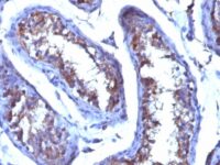 Formalin-fixed. Paraffin-embedded human Testicular Carcinoma stained with Testosterone Monoclonal Antibody (4E1G2)