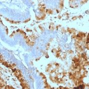 Formalin-fixed, paraffin-embedded human Colon Carcinoma stained with Lewis A Monoclonal Antibody (7LE).