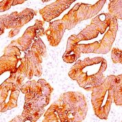 Formalin-fixed, paraffin-embedded human Colon Carcinoma stained with Multi Cytokeratin Monoclonal Antibody (C11).