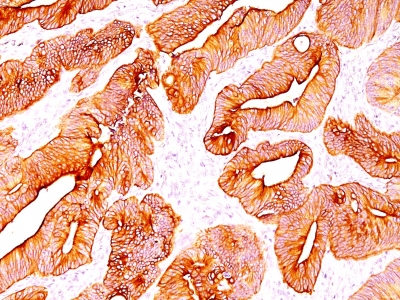 Formalin-fixed, paraffin-embedded human Colon Carcinoma stained with Multi Cytokeratin Monoclonal Antibody (C11).