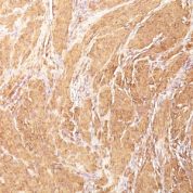 Formalin-fixed, paraffin-embedded human Rhabdomyosarcoma stained with Muscle Specific Actin Monoclonal Antibody (HHF35)