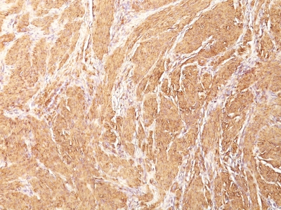 Formalin-fixed, paraffin-embedded human Rhabdomyosarcoma stained with Muscle Specific Actin Monoclonal Antibody (HHF35)
