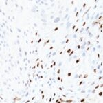 Formalin-fixed, paraffin-embedded human Cervix stained with HPV-16 Monoclonal Antibody (SPM45)