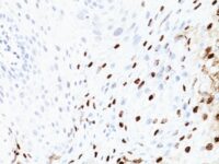 Formalin-fixed, paraffin-embedded human Cervix stained with HPV-16 Monoclonal Antibody (SPM45)