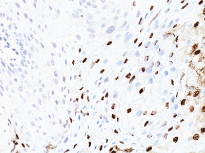 Formalin-fixed, paraffin-embedded human Cervix stained with HPV-16 Monoclonal Antibody (SPM45)