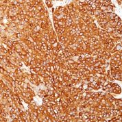 Formalin-fixed, paraffin-embedded human Melanoma stained with Melanoma Marker Monoclonal Antibody (M2-7C1 + M2-9E3 + T311 + HMB45).