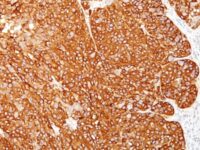 Formalin-fixed, paraffin-embedded human Melanoma stained with Melanoma Marker Monoclonal Antibody (M2-7C1 + M2-9E3 + T311 + HMB45).