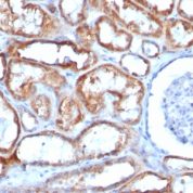 Formalin-fixed, paraffin-embedded human Testicular Carcinoma stained with Mitochondria Monoclonal Antibody (113-1).