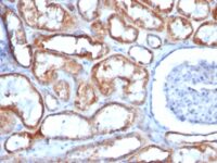 Formalin-fixed, paraffin-embedded human Testicular Carcinoma stained with Mitochondria Monoclonal Antibody (113-1).