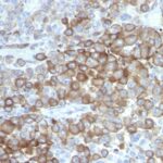 Formalin-fixed, paraffin-embedded human Melanoma stained with PNL2 Monoclonal Antibody.