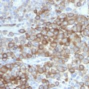 Formalin-fixed, paraffin-embedded human Melanoma stained with PNL2 Monoclonal Antibody.