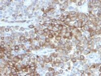 Formalin-fixed, paraffin-embedded human Melanoma stained with PNL2 Monoclonal Antibody.