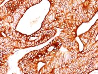 Formalin-fixed, paraffin-embedded human Colon Carcinoma stained with Cytokeratin 5/8 Monoclonal Antibody (SPM268).